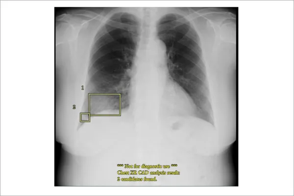 胸部レントゲンAI画像診断支援システム（エルピクセル社製 EIRL Chest）